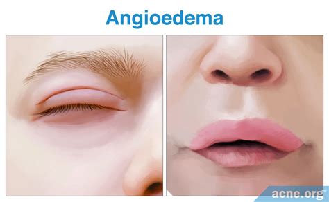 Hives Urticaria