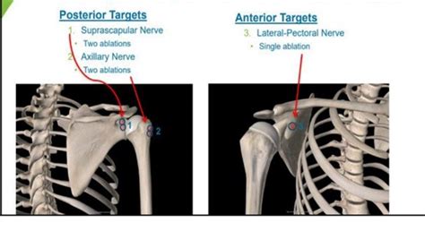 Shoulder Joints Nerve Block Radiofrequency Ablation Solutions In Pain