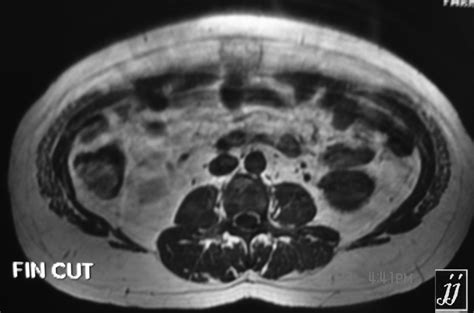 abdomen supra umbilical hernia  radioogle