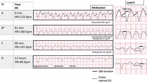 Atrial Fibrillation Vs Atrial Flutter Ecg