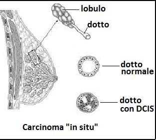 Carcinoma Mammario Duttale In Situ DCIS FertilityCenter