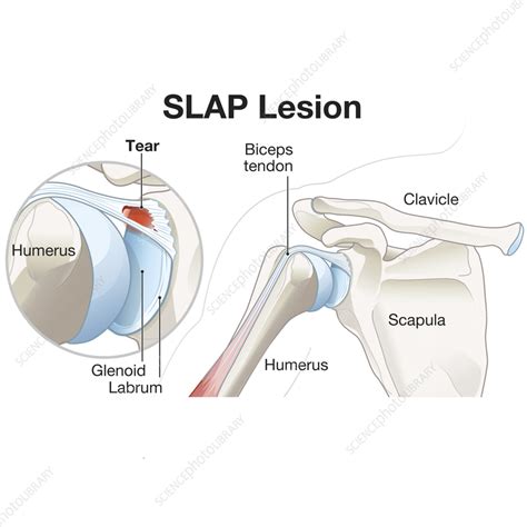 SLAP Lesion Of The Shoulder Illustration Stock Image C058 7237