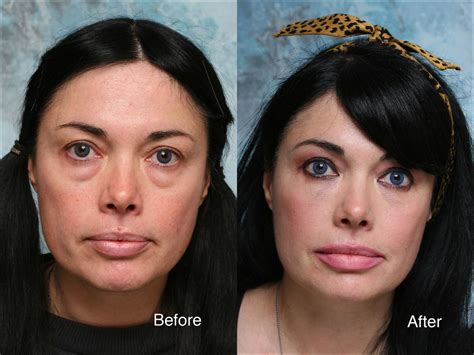 Side Effects Of The Blepharoplasty Surgical Treatment Flickr