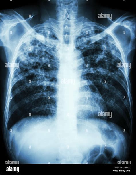 Pulmonary Tuberculosis Film Chest X Ray Show Interstitial Infiltration Both Lung Due To