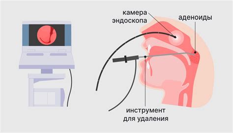 Альвеолит - что это, причины и лечение