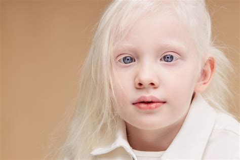 Comment Prendre Soin De La Peau D Un Enfant Albinos