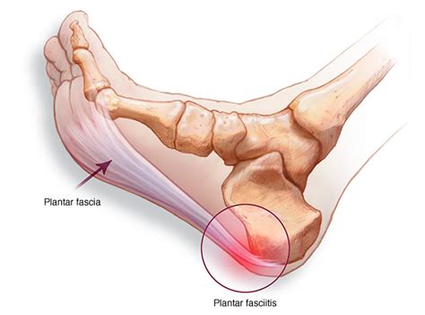 Fascitis Plantar Sus Causas Y Tratamiento Omimed