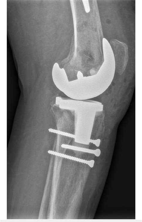 Lateral X Ray Of Tka And Tibial Tuberosity Fixation Tka Total Knee