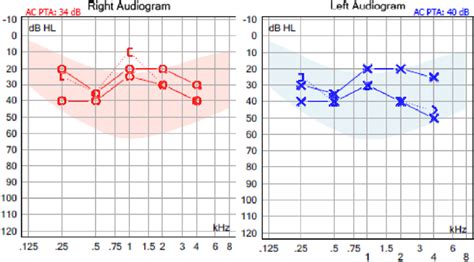 Pure Tone Audiometry With And Without Hearing Aids In Case 2