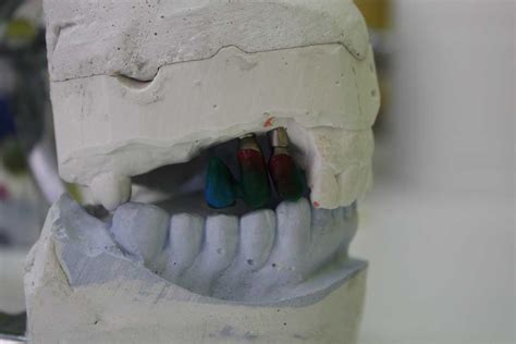 Implants With A Cantilever