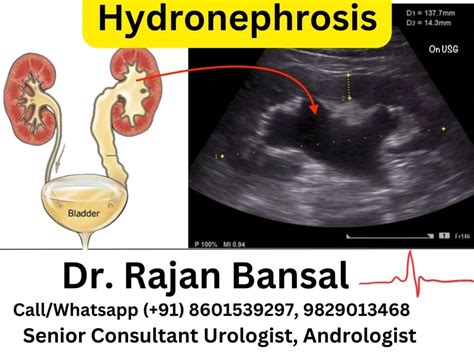 hydronephrosis  normal kidney ultrasound kidney ultrasound