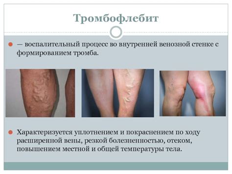 Тромбофлебит презентация, доклад