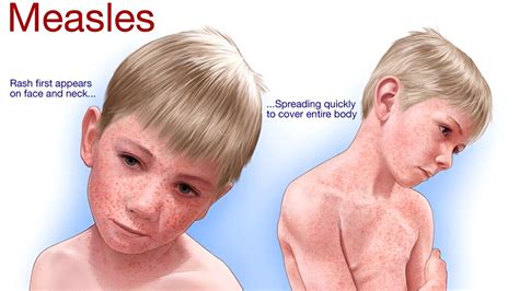 Preventing Measles Outbreaks In The Us Through Vaccination