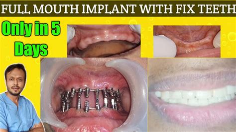 Live Full Mouth Dental Implant Procedure Completed Within 5 Days Only Youtube