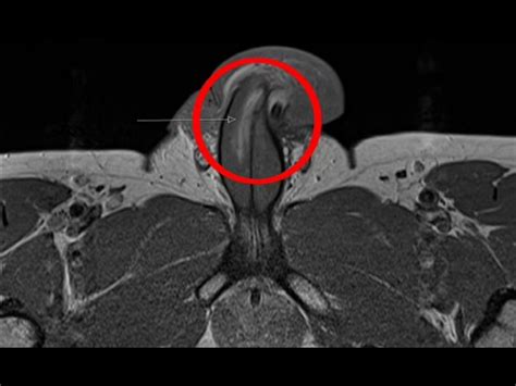 Man Breaks Penis Vertically While Having Sex British Man Becomes First In The World To Break