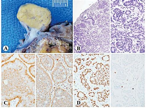 Well Differentiated Neuroendocrine Tumor Net Of The Terminal Ileum