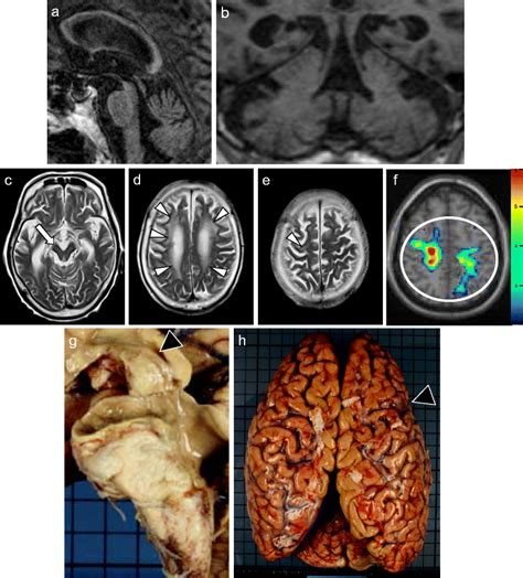 Mri Of An Year Old Female Patient With Pathologically Proven Psp