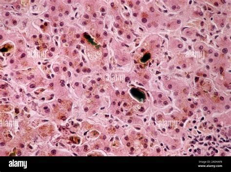 Blockage Of Bile Ducts Light Micrograph Of A Section Through Liver