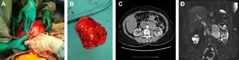 PEComa Tumor Radiological Imaging And Resection A Intraoperative