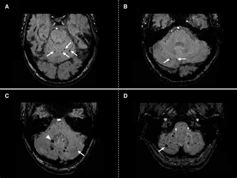 Cerebellar Microbleed Distribution Patterns And Cerebral Amyloid