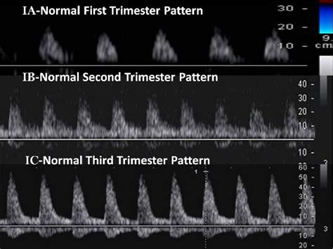 A Classification Of Patterns Of Fetal Middle Cerebral Artery Velocity Waveforms As Seen On