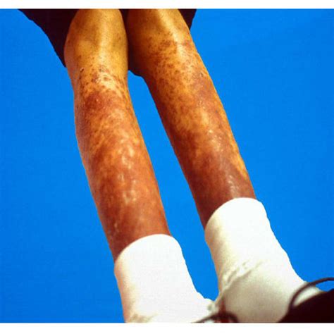 Sarcoidosis Skin Rash Lesions