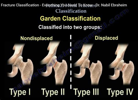 Femoral Neck Fracture Complications Lopigraph