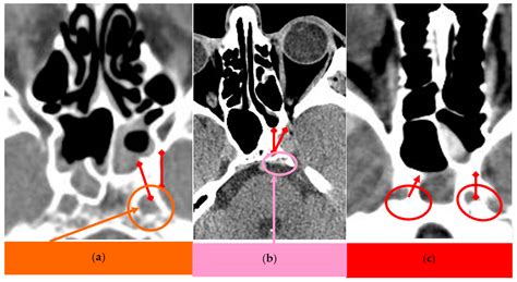 Medicina Free Full Text Anatomical Variants Of Internal Carotid