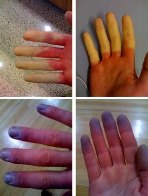 Febre Com Extremidades Geladas O Que Fazer - Corrida no frio: como evitar que dedos e partes do corpo acabem congeladas