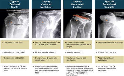 Reverse Total Shoulder Arthroplasty For Rotator Cuff Arthropathy