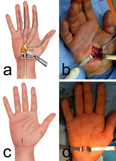 A Schematic Representation Of The Classic Open Carpal Tunnel Release