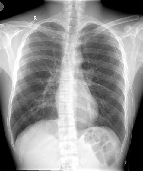 Subcutaneous Emphysema Chest Tube