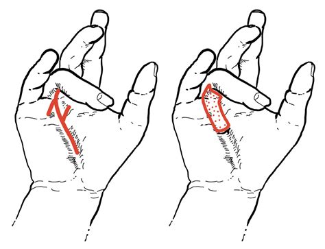 Dupuytrens Contracture Cost Risks Recovery