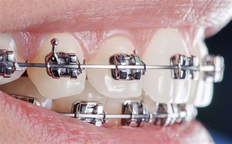 How Do Braces Work To Straighten Your Teeth Devonshire