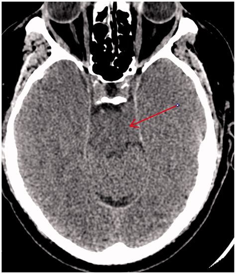 Herniation Of Uncus And Parahippocampal Gyrus An Accidental Finding On