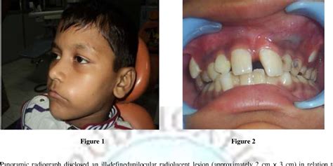 Figure 1 From Unicystic Ameloblastoma In Anterior Maxilla A Rare Case