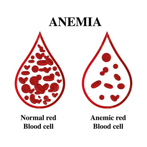 anemia iron red blood cell medical vector illustration anemia blood cell png  vector