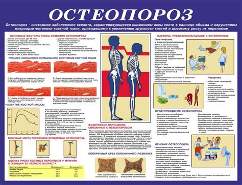 Лечение остеопороза позвоночника у пожилых женщин препараты схема лечения