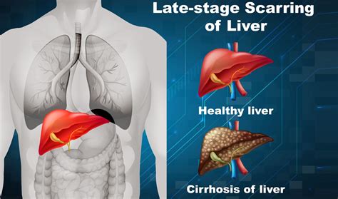 What Is Liver Cirrhosis Medicus Network Find Your Medical