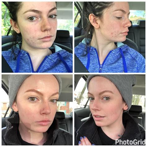 B A Ive Never Felt So Confident In My Naked Skin Info In The Comments R SkincareAddiction