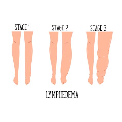 guide  lymphedema treatment prn home health  therapy