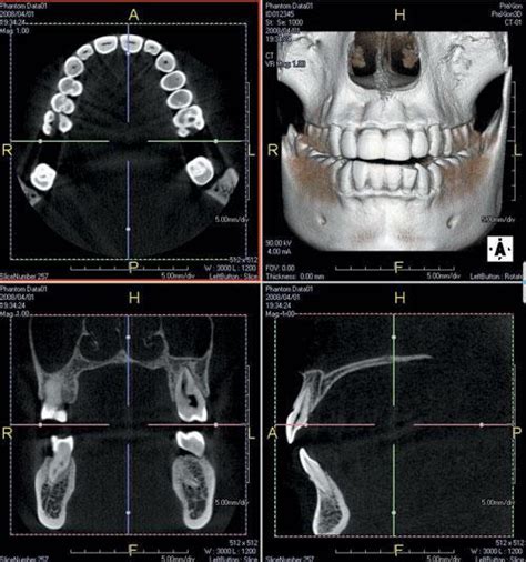 Dental Cbct What Is It