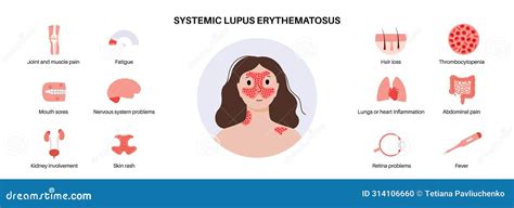 Systemic Lupus Erythematosus Stock Vector Illustration Of