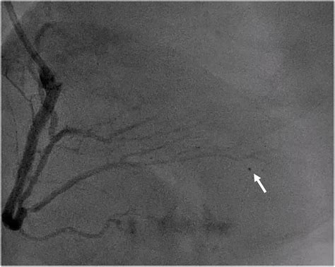 Tctap C A Challenging Case Report A Novel Approach In Distal