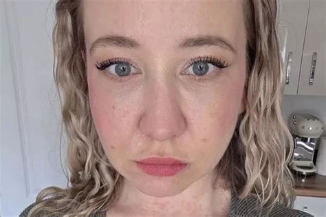 Mum Left With Gruesome Rash After Getting In Dirty Hot Tub At Luxury Lodge Coventrylive