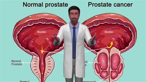 Preventing Prostate Cancer, mens health doctor near me