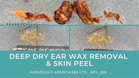 Deep Dry Ear Wax Removal And Skin Peel Ep 209 Youtube