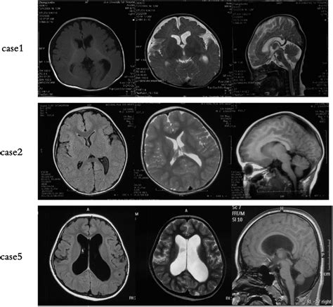 Brain magnetic resonance imaging (MRI). Brain MRI of Patients 1, 2 and ...