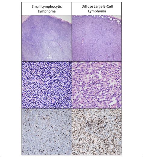 A comparison of the patient's small lymphocytic lymphoma (SLL) and... | Download Scientific Diagram