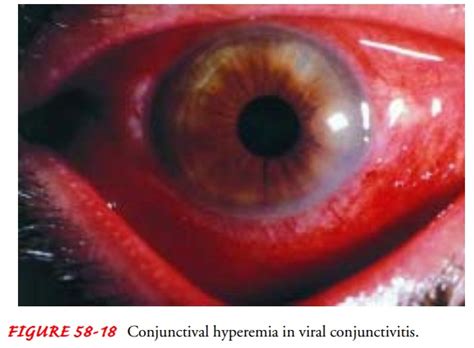 Conjunctival Hyperemia